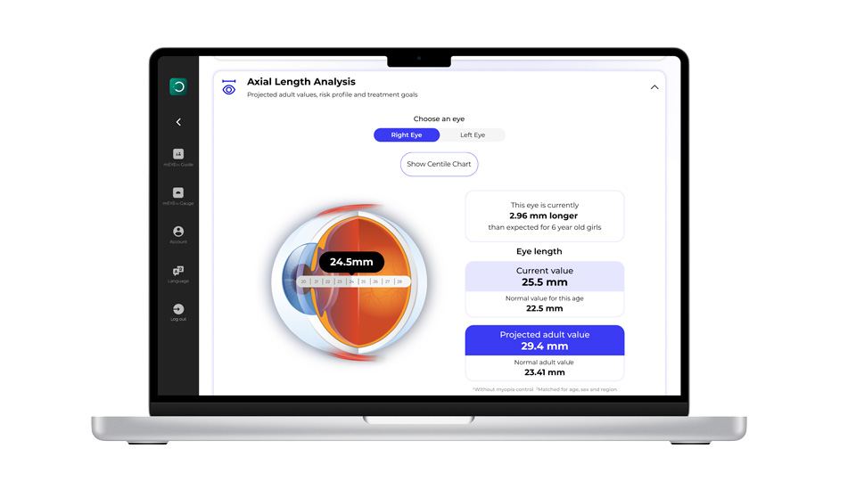 A laptop screen shows an illustration of an eye and information about axial length analysis