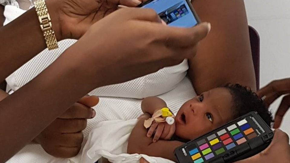 Using smartphone images to predict whether children have anaemia - Vimarsana News