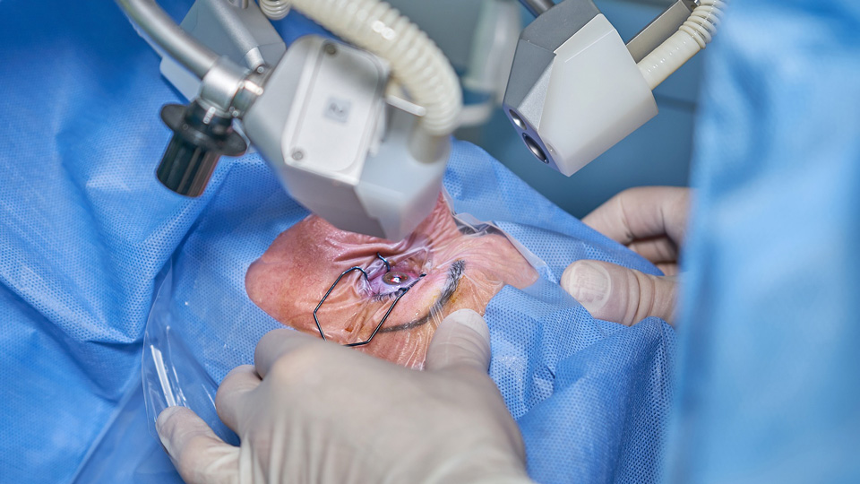 eye laser surgery