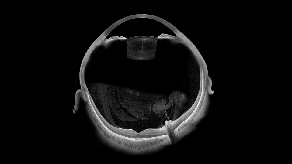 An image that shows a black and white cross-section of an eye. The image is assembled from many OCT images of the posterior and anterior of the eye 