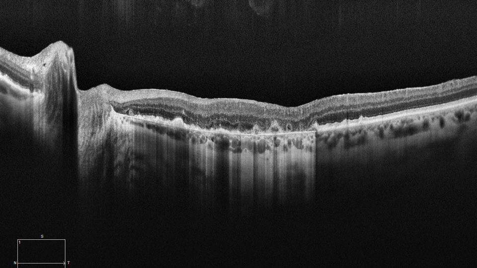 A black and white scan of the eye which indicates geographic atrophy 