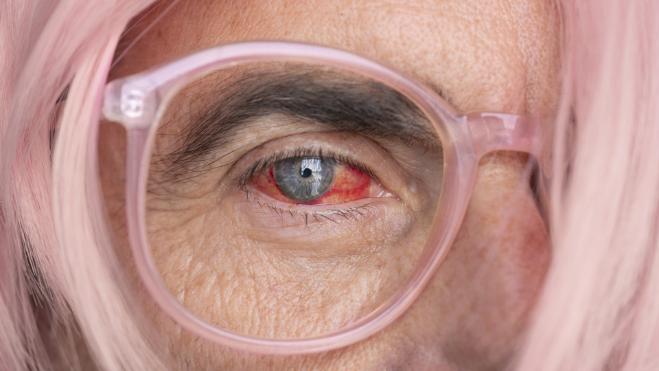 Close up of an older woman with pink hair and an inflamed red eye 