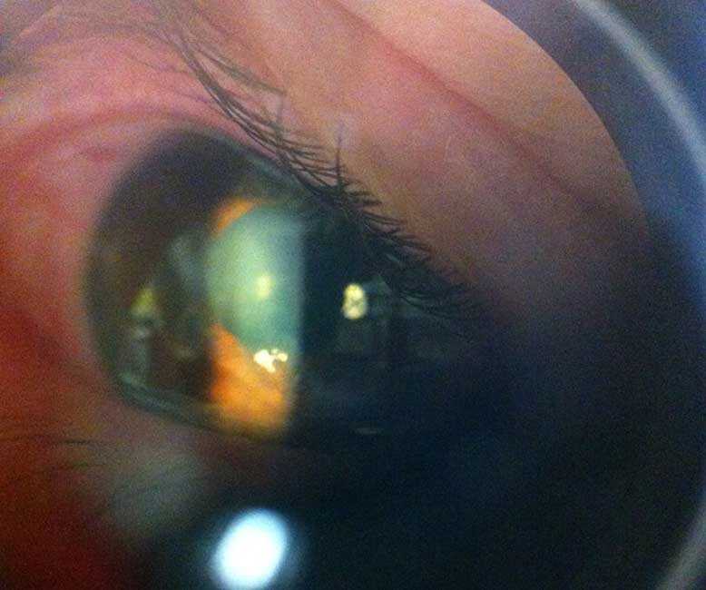 Glitter in eye