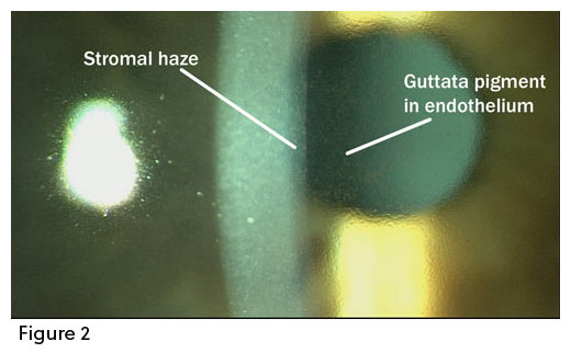 Fuchs Grading Managing cataract patients with Fuchs' endothelial dystrophy