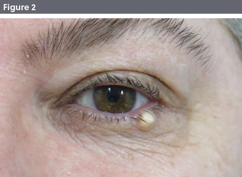 Upper Eyelid Lesions